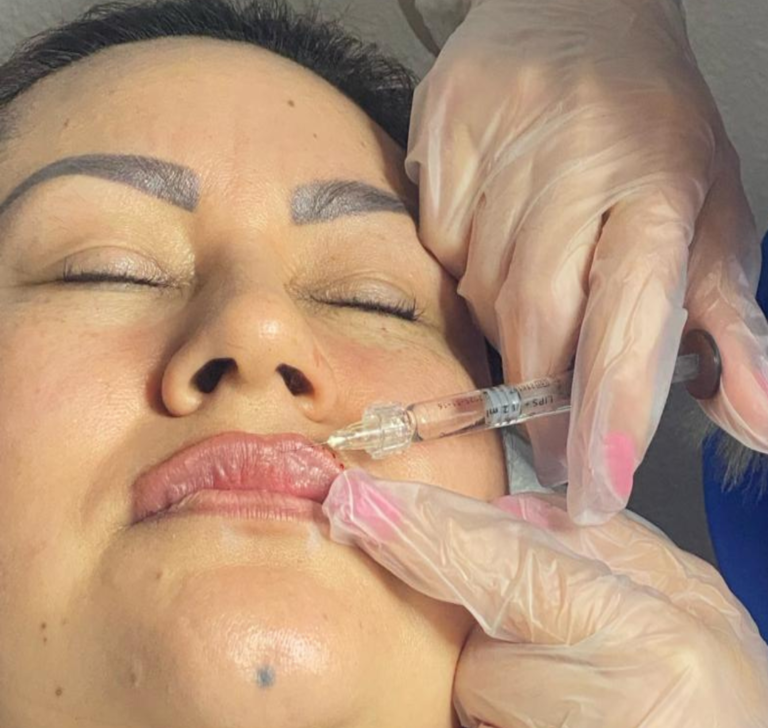 Antes y después de tratamiento con fillers en labios para mayor volumen y definición