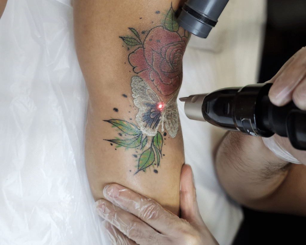 écnica profesional de eliminación de tatuajes con láser en Paloma Clinic Spa