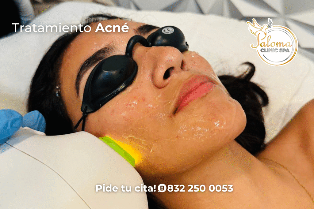 Persona recibiendo tratamiento facial para acné en Paloma Clinic Spa Stafford