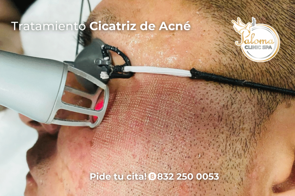 Comparación antes y después de tratamiento láser para cicatrices en Paloma Clinic Spa Stafford