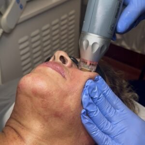 Microneedling con radiofrecuencia en Houston para rejuvenecimiento facial
