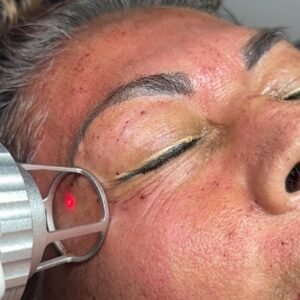 Mujer recibiendo tratamiento estético con láser CO2 en el párpado para levantar los párpados caídos sin cirugía