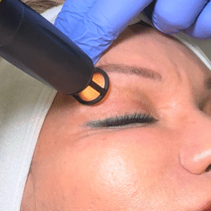 Mujer recibiendo tratamiento de rejuvenecimiento facial con Láser Erbium, enfocando en rostro y manos